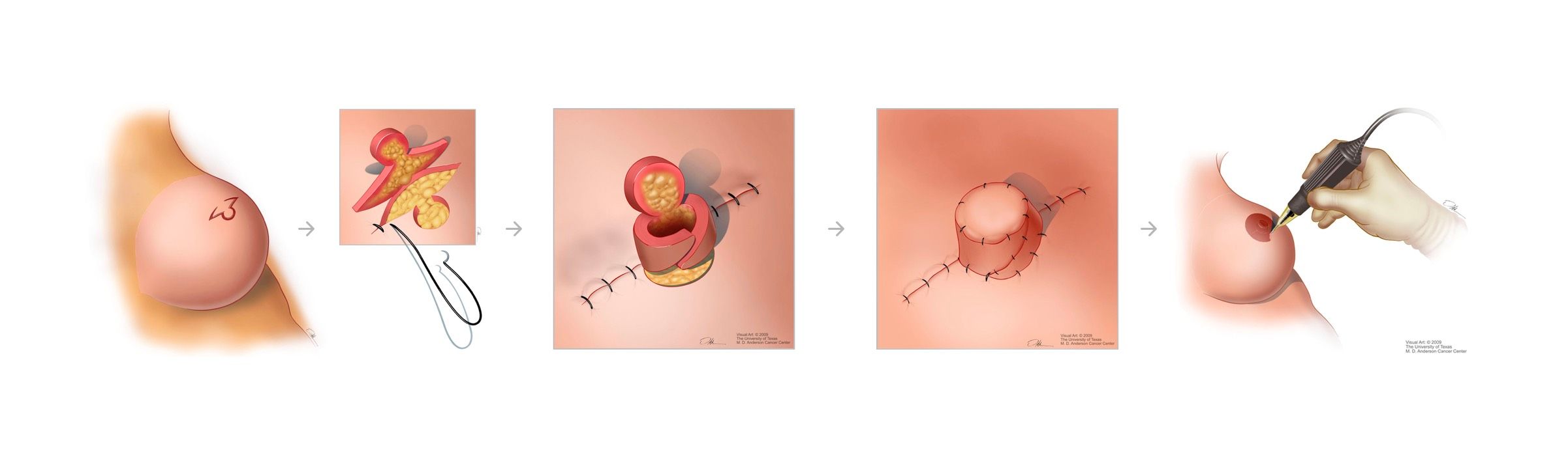 Nipple reconstruction